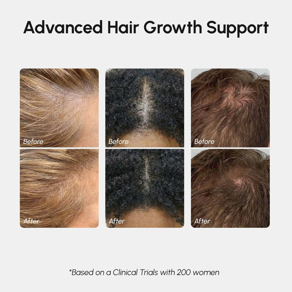 Hair Growth Spray – Caffeine, Batana, Castor & Rosemary Oil for Hair Growth – Products for Women & Men – Hair Oils for Hair Growth – Hair Thickening Spray for Roots – Hair Regrowth & Scalp Care